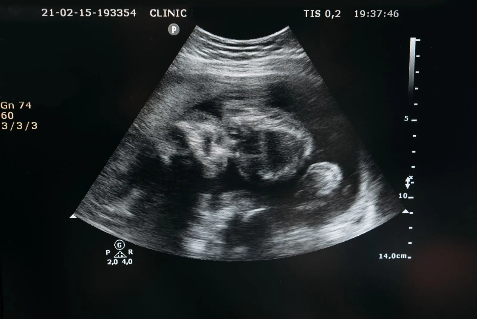 Écran d'échographie en noir et blanc montrant le profil d'un bébé.